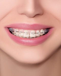 Closeup Ceramic and Metal Braces on Teeth. Beautiful Female Smile with Brackets. Orthodontic Treatment. Front View.