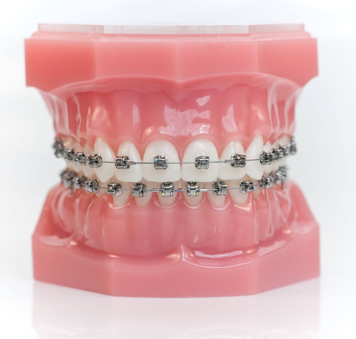 The Benefits of Damon Clear and Metal Braces
