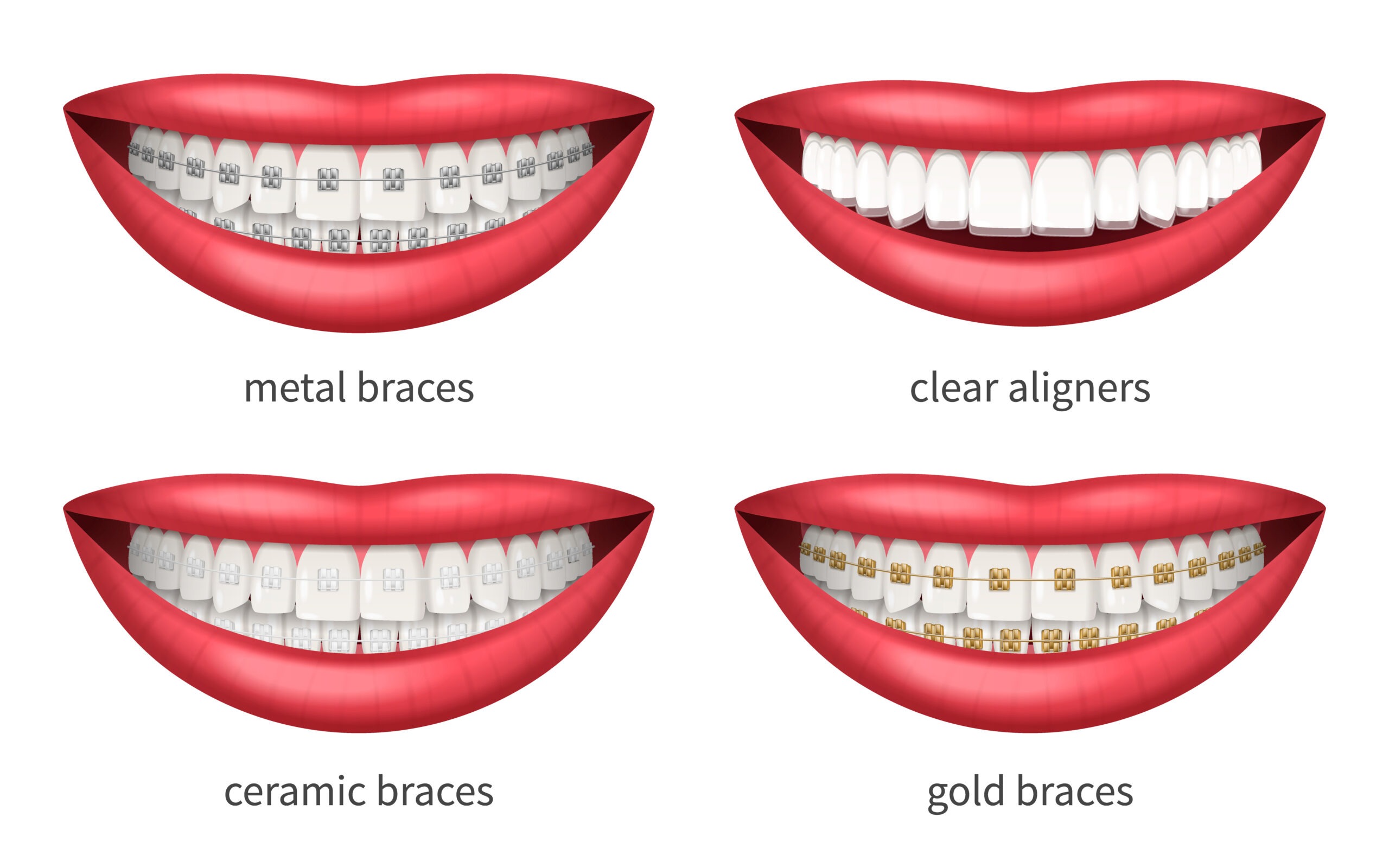Tips for Successfully Wearing Braces