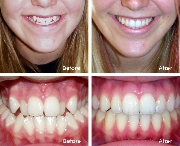 Before and After Invisalign