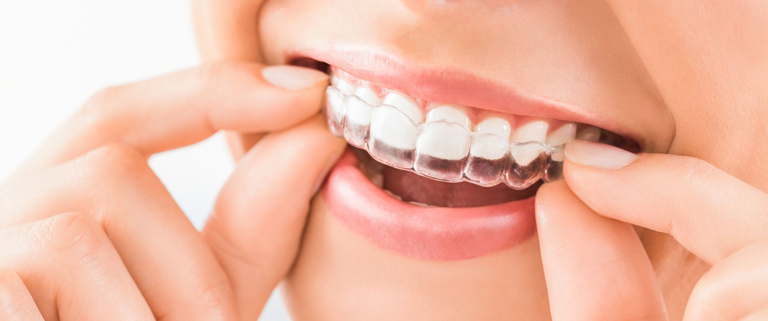 Everything to know about Invisalign